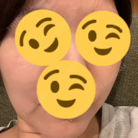白玉点滴・注射 おおたかの森ビューティークリニック AFTER