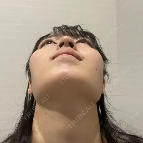 鼻尖形成（切開） / 軟骨移植 R Beauty CLINIC 名古屋院 AFTER