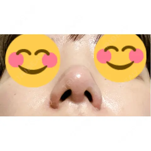 鼻尖形成（切開） / 軟骨移植 / 鼻翼挙上 / 鼻修正 / その他（鼻） 東京シンデレラ美容外科 大宮院 AFTER