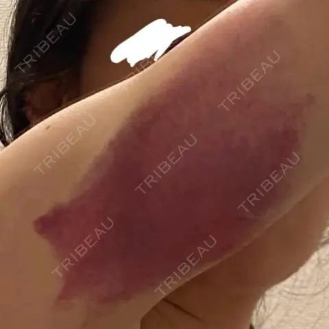 脂肪冷却（二の腕） LE CLINIC DAY 0