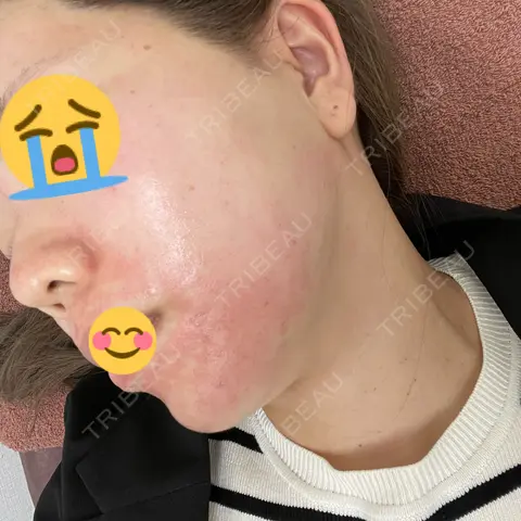 ピコフラクショナルレーザー（毛穴・ニキビ跡） DAILY SKIN CLINIC 福岡院 DAY 0