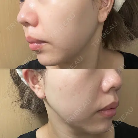 ピコフラクショナルレーザー（毛穴・ニキビ跡） DAILY SKIN CLINIC 福岡院 AFTER