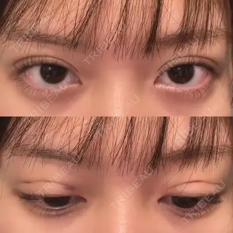 二重埋没 湘南美容クリニック 博多院 DAY 0