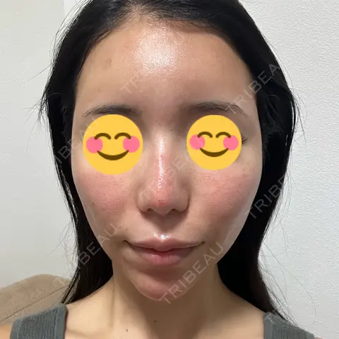 ポテンツァ LUNA BEAUTY CLINIC 池袋駅前院 AFTER