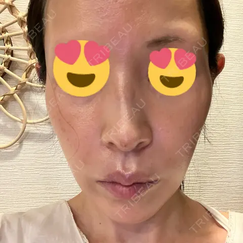 ヒアルロン酸注入（鼻） / ヒアルロン酸注入（頬） / ボトックス（眉間） HAAB BEAUTY CLINIC 名古屋院 DAY 0