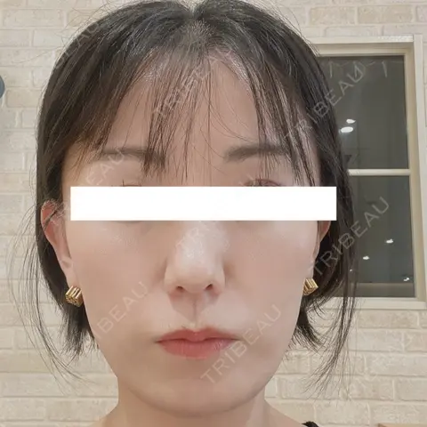 PRP皮膚再生療法 ノリス美容クリニック DAY 1