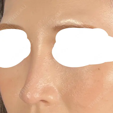 隆鼻術 / 鼻尖形成（切開） / 鼻中隔延長（切開） / クマ治療 / 軟骨移植 R Beauty CLINIC 大阪院 AFTER