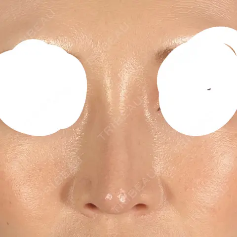 隆鼻術 / 鼻尖形成（切開） / 鼻中隔延長（切開） / クマ治療 / 軟骨移植 R Beauty CLINIC 大阪院 AFTER