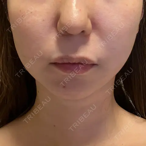 糸リフト / 脂肪吸引（顔） RIVER CLINIC（リバークリニック） DAY 0