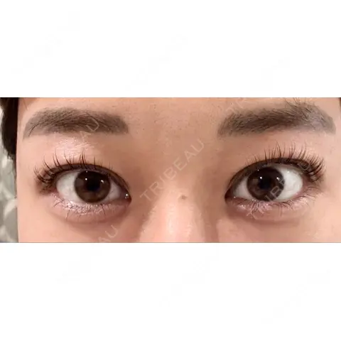ヒアルロン酸注入（涙袋） / ボトックス（エラ・小顔） / ボトックス（額） AI Beauty Clinic （エーアイ美容クリニック） AFTER