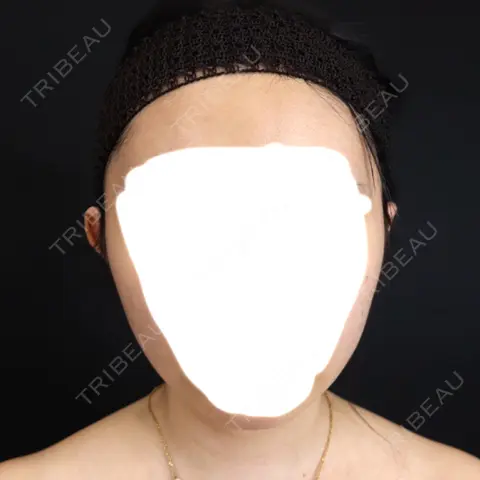 脂肪吸引（顔） / 脂肪吸引（二の腕） / 脂肪吸引（肩） 藤・ナチュレ美容クリニック 銀座院 AFTER