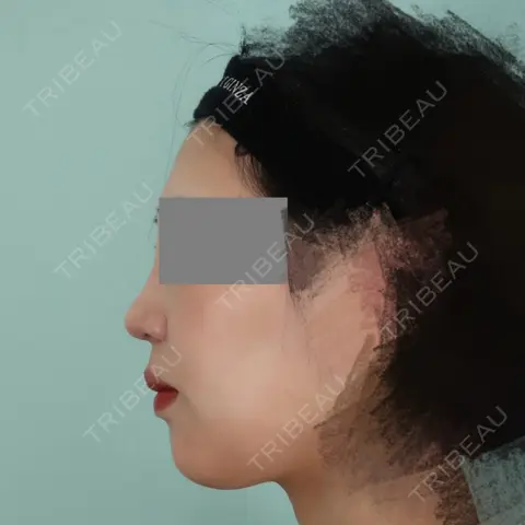 小鼻縮小（切開） / 軟骨移植 / 鼻孔縁挙上 WOM CLINIC GINZA （ワム クリニック ギンザ） AFTER