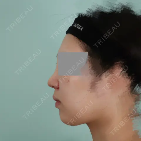 小鼻縮小（切開） / 軟骨移植 / 鼻孔縁挙上 WOM CLINIC GINZA （ワム クリニック ギンザ） AFTER