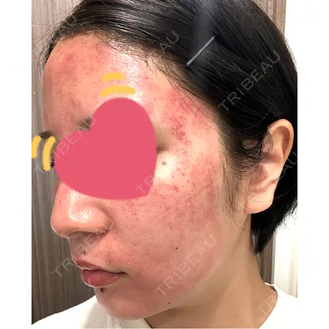 ダーマペン Re:anne clinic 銀座 【リアンクリニック銀座】 DAY 0