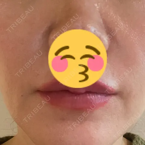 ヒアルロン酸注入（鼻翼基部） L‘amour clinic Tokyo【ラムールクリニック東京】 AFTER