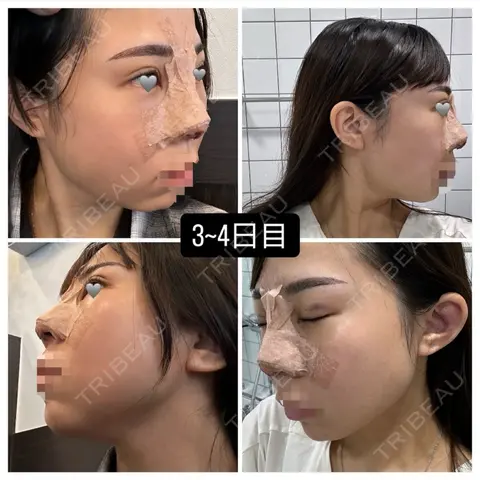 隆鼻術 / 鼻中隔延長（切開） / 軟骨移植 / 骨切幅寄せ / 眉間プロテーゼ / 自然癒着法 / その他（目元） LUHO（ルホ）美容外科 DAY 3