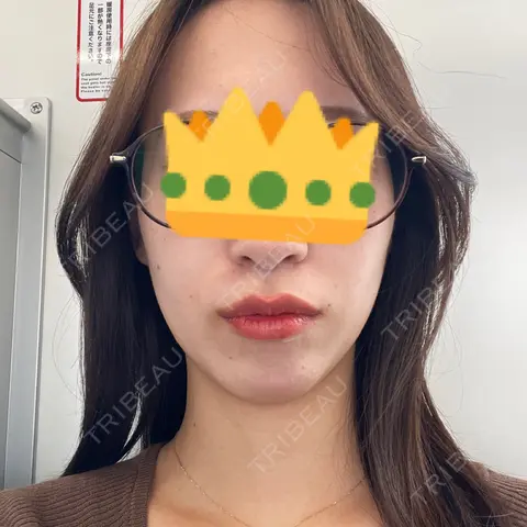 ヒアルロン酸注入（あご） HAAB×DREAM BEAUTY CLINIC 東京本院 AFTER
