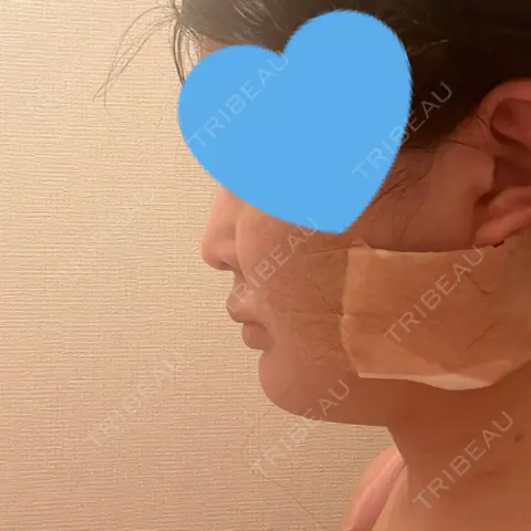 脂肪吸引（顔） 東京美専クリニック AFTER