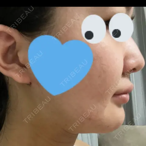 脂肪吸引（顔） 東京美専クリニック AFTER