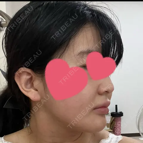 脂肪吸引（顔） 東京美専クリニック AFTER