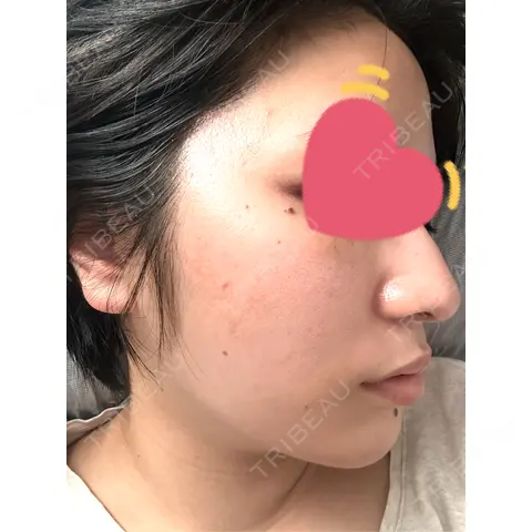 ダーマペン Re:anne clinic 銀座 【リアンクリニック銀座】 AFTER