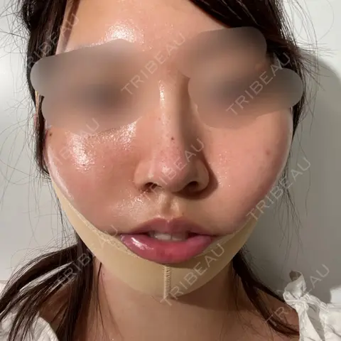 脂肪吸引（顔） oggi clinic DAY 0