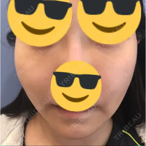 クマ治療 / 再生医療 湘南美容クリニック 渋谷院 AFTER