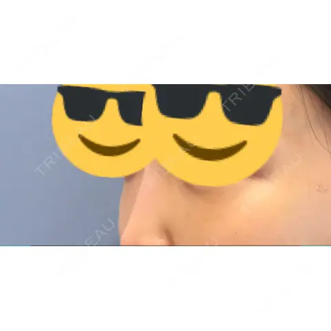 クマ治療 / 再生医療 湘南美容クリニック 渋谷院 AFTER