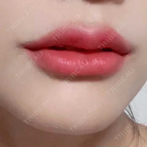 ヒアルロン酸注入（唇） R Beauty CLINIC 銀座院 AFTER