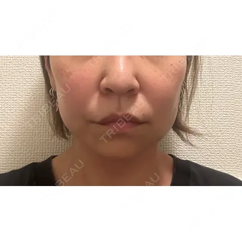 脂肪溶解注射（顔） ROOTS Clinic DAY 0