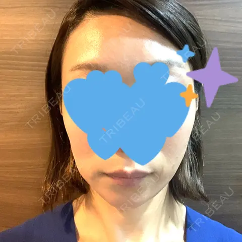 ヒアルロン酸注入（頬） APスキンクリニック銀座 DAY 0