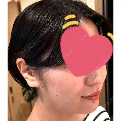 ダーマペン Re:anne clinic 銀座 【リアンクリニック銀座】 AFTER
