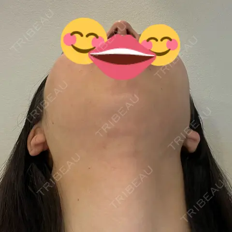 脂肪吸引（顔） oggi clinic AFTER