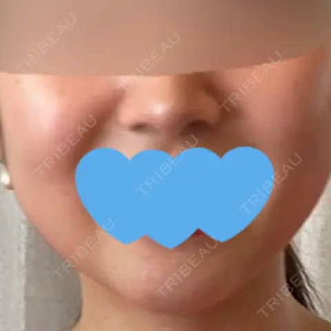 脂肪吸引（顔） oggi clinic AFTER