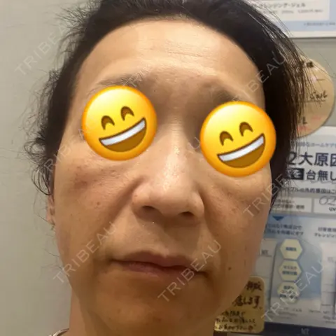 イオン導入 / ピーリング（ハリ・ツヤ） / ルメッカ ルラ美容クリニック 千葉院 DAY 0