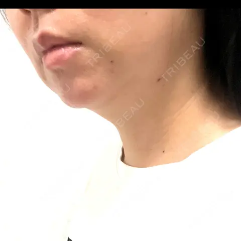 脂肪溶解注射（顔） / ハイフ（顔） AZ BEAUTY CLINIC DAY 0
