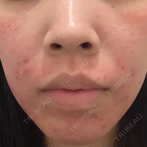 ニードルRF（ポテンツァなど） ARTE SKIN CLINIC 【アルテスキンクリニック】 DAY 0