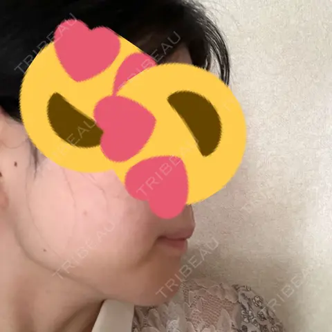 脂肪吸引（顔） Mods Clinic（モッズクリニック） 東京院 AFTER