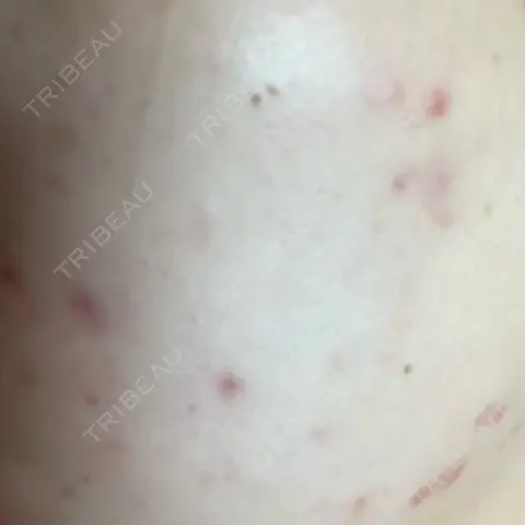 ニードルRF（ポテンツァなど） ARTE SKIN CLINIC 【アルテスキンクリニック】 AFTER