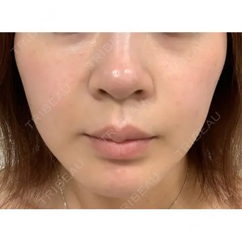 美容点滴・美容注射（ダイエット） / 美容点滴・美容注射（疲労回復） / ピコレーザートーニング（美白・肝斑） / ピーリング（ハリ・ツヤ） / ピコフラクショナルレーザー（毛穴・ニキビ跡） 表参道メディカルクリニック 大阪院 AFTER