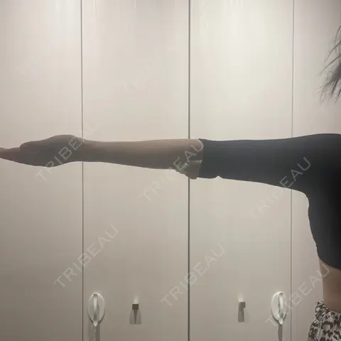 脂肪吸引（二の腕） ルラ美容クリニック 千葉院 DAY 0