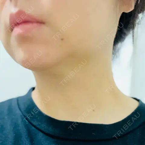脂肪溶解注射（顔） / ハイフ（顔） AZ BEAUTY CLINIC AFTER