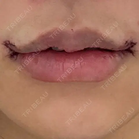 口角挙上 / ヒアルロン酸注入（唇） R Beauty CLINIC 銀座院 DAY 0