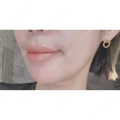 肌ヒアルロン酸注入（たるみ・シワ改善） / ヒアルロン酸注入（あご） LE CLINIC DAY 0