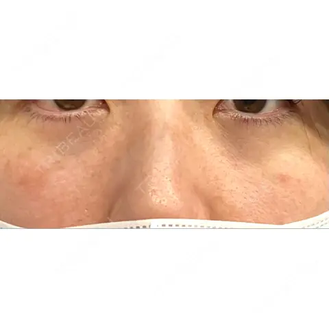 クマ治療 / 下まぶたの脂肪取り ROOTS Clinic DAY 0