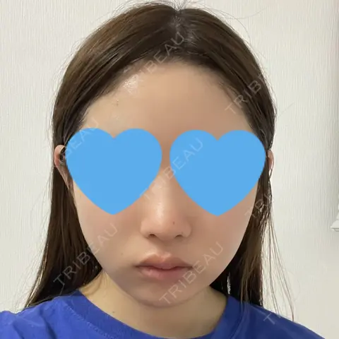 糸リフト / 脂肪吸引（顔） / 脂肪吸引注射（顔） SEA CLINIC（シークリニック） DAY 9