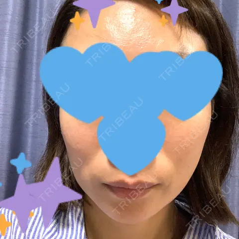 ヒアルロン酸注入（頬） APスキンクリニック銀座 AFTER
