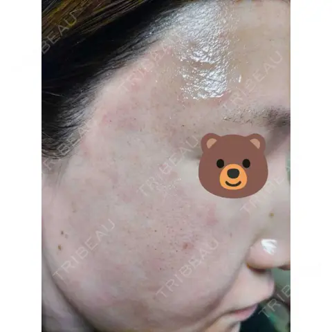 ヴェルヴェットスキン ブリリアスキンクリニック DAY 0