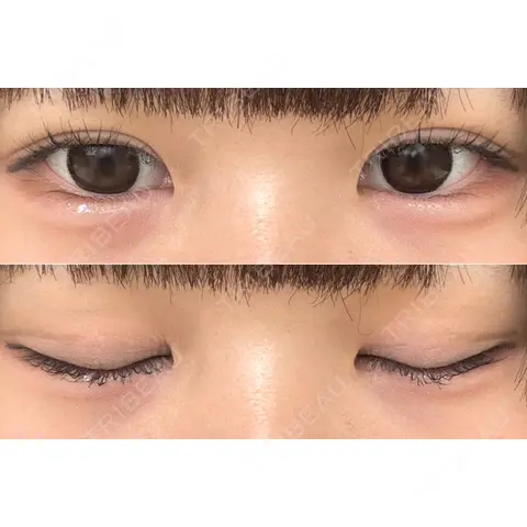 二重埋没 / 上まぶたの脂肪取り THE FIRST CLINIC 多摩センター院 AFTER