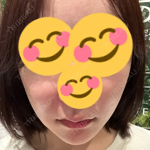 脂肪溶解注射（顔） あいち栄クリニック AFTER